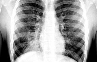Já há 76 casos de Legionella do surto em Vila do Conde, Póvoa de Varzim e Matosinhos e 8 mortes