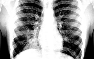 Já há 87 casos de Legionella do surto em Vila do Conde, Póvoa de Varzim e Matosinhos e 10 mortes