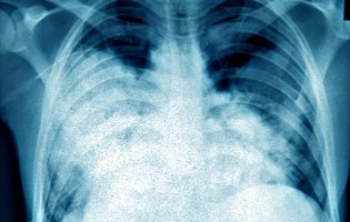 Já há 85 casos de Legionella do surto em Vila do Conde, Póvoa de Varzim e Matosinhos e 9 mortes