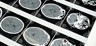 Sobreviventes de Acidente Vascular Cerebral reaprendem a viver no Hospital da Prelada