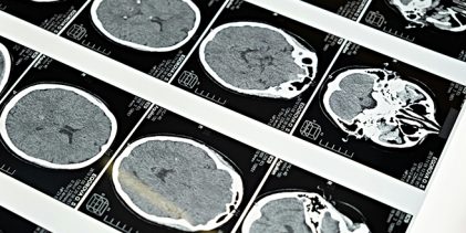 Sobreviventes de Acidente Vascular Cerebral reaprendem a viver no Hospital da Prelada