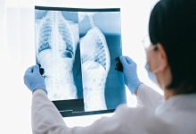 Infeção nos adultos por vírus que causa bronquiolites pode ser mais perigosa que gripe