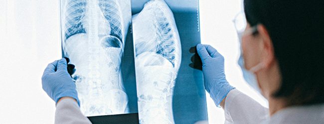 Infeção nos adultos por vírus que causa bronquiolites pode ser mais perigosa que gripe